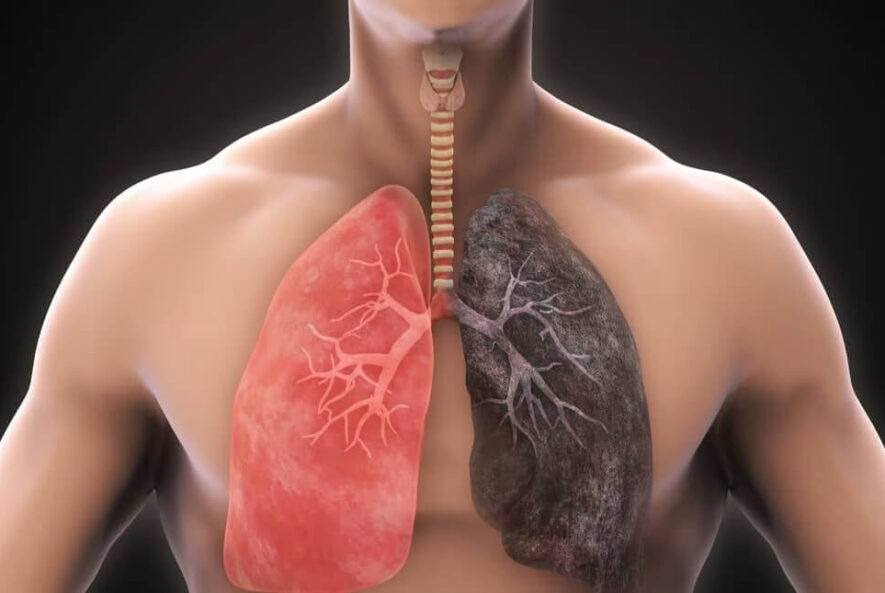 Chronic Obstructive Pulmonary Disease