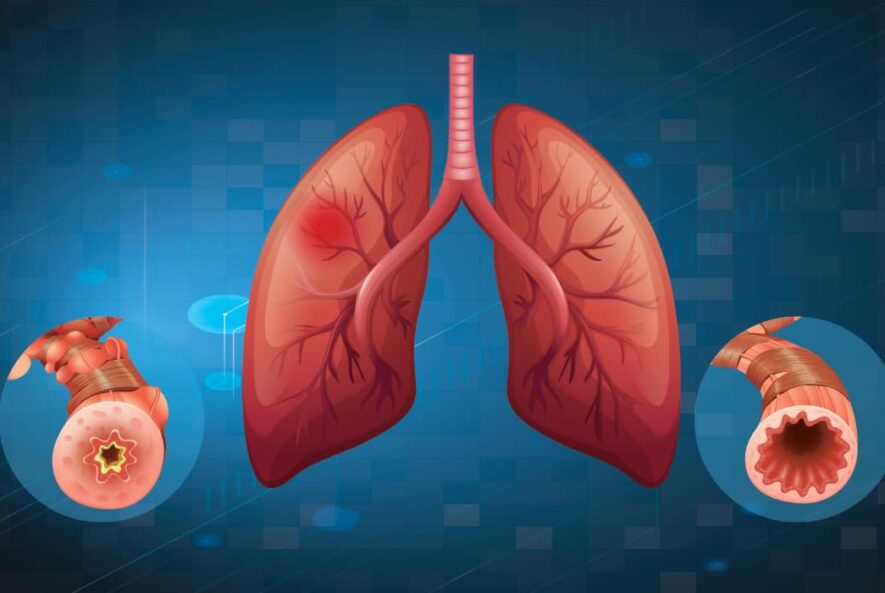 Interstitial lung disease (ILD)