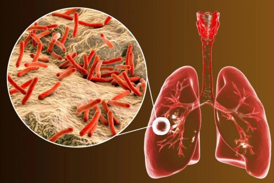Tuberculosis - Best Tuberculosis Doctors in Gurgaon -Dr Shivanshu