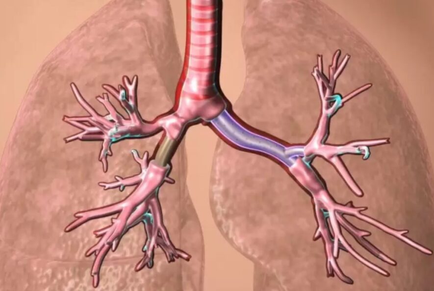 Tracheobronchial Stenting