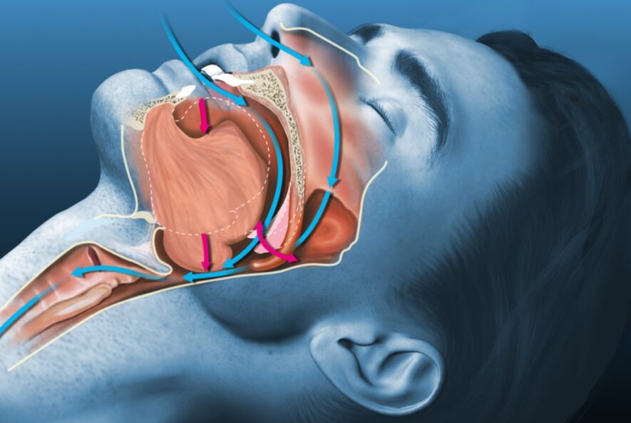 Ostructive Sleep Apnea in Adults - Dr Shivanshu Goyal