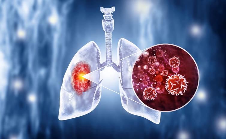 Early Signs of Lung Cancer - Lung Cancer Specialist in Gurgaon