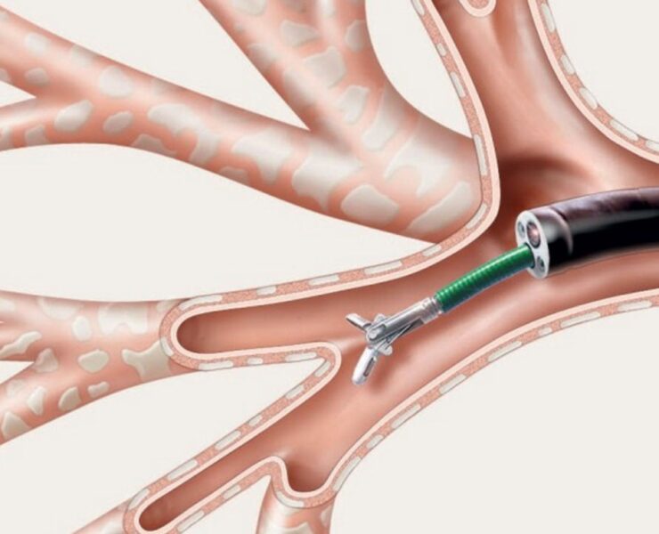 Flexible Bronchoscopy for Lung Cancer - Dr Shivanshu Raj Goyal