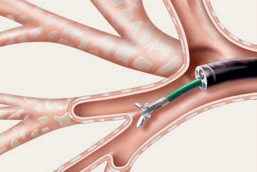 Flexible Bronchoscopy for Lung Cancer - Dr Shivanshu Raj Goyal