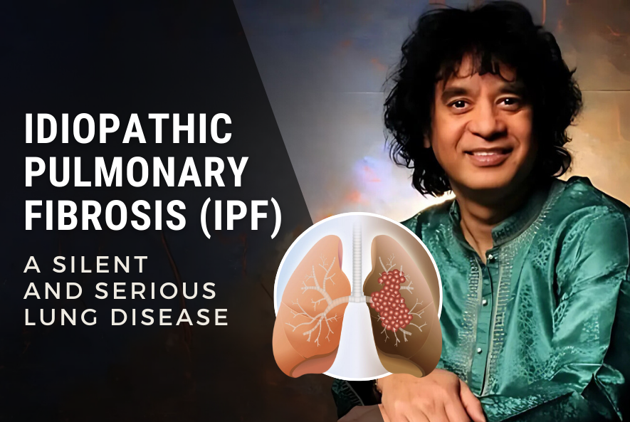 Idiopathic Pulmonary Fibrosis (IPF) - A Silent and Serious Lung Disease - Dr Shivanshu Raj Goyal