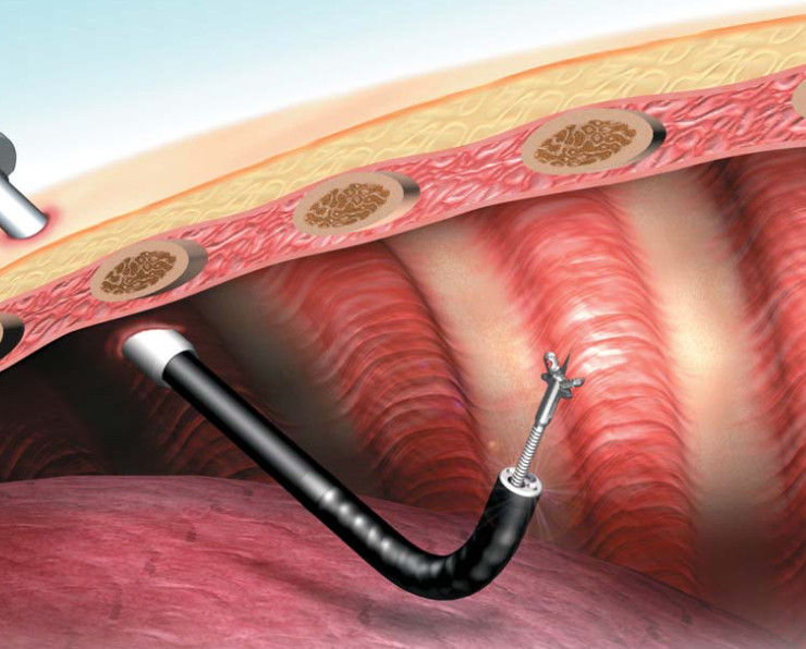 Role of Thoracoscopy in Managing Lung Cancer & Pleural Effusion