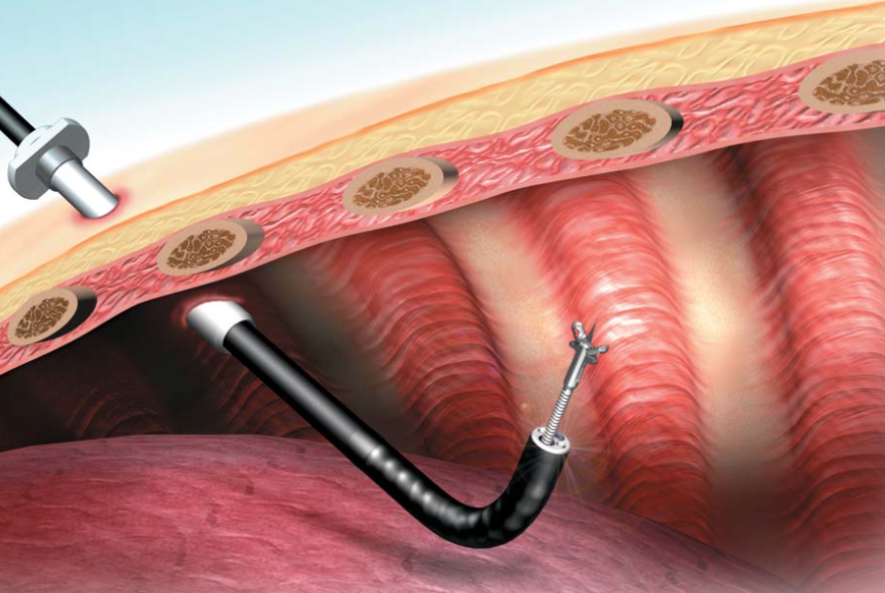 Role of Thoracoscopy in Managing Lung Cancer & Pleural Effusion