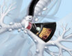Understanding EBUS: A Minimally Invasive Procedure for Lung Diagnosis with Dr. Shivanshu Goyal