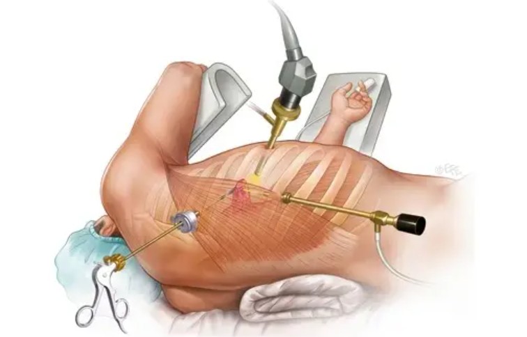 Best Thoracoscopy Doctor in Gurgaon - Dr Shivanshu Raj Goyal