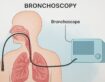 Bronchoscopy: Why It’s Done and What to Expect