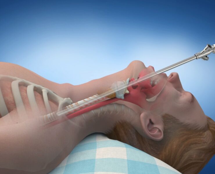 Best Doctor for Bronchoscopy in Delhi – Dr. Shivanshu Raj Goyal