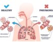 How Do You Know If You Are Down With Pneumonia? Signs You Shouldn’t Ignore
