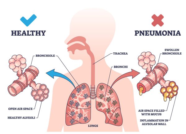 Best Pneumonia Specialist in Gurgaon - Dr Shivanshu Raj Goyal