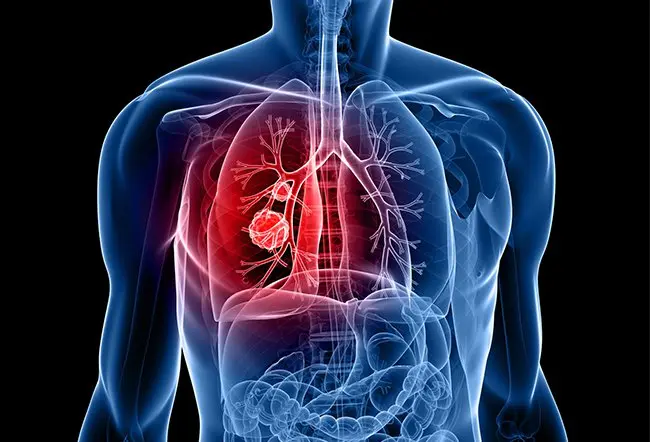 Silent Lung Diseases – The Hidden Threat to Your Health
