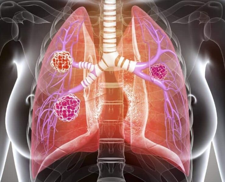 Best Pulmonologist in Varanasi - Expert Care for Lung Disease