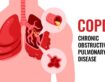 COPD Treatment in Kanpur – Dr Shivanshu Raj Goyal