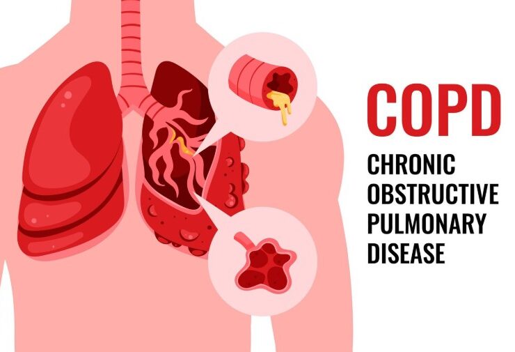 COPD Treatment in Kanpur - Dr. Shivanshu Raj Goyal