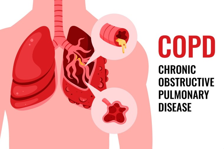 COPD Treatment in Kanpur - Dr. Shivanshu Raj Goyal