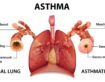 Top Asthma Specialist in Rohtak – Dr Shivanshu Raj Goyal