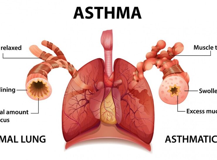Top Asthma Specialist in Rohtak - Dr. Shivanshu Raj Goyal