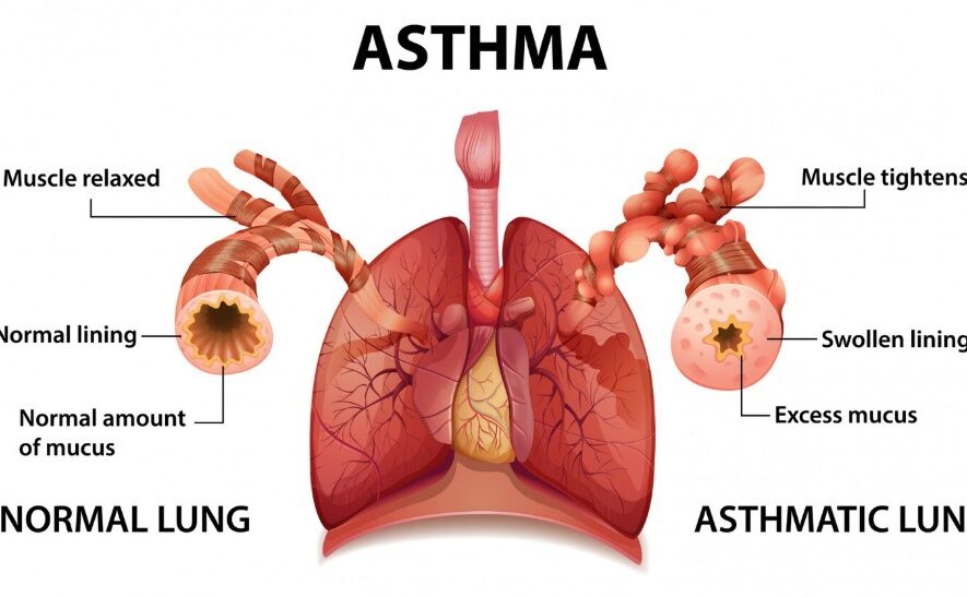 Top Asthma Specialist in Rohtak - Dr. Shivanshu Raj Goyal